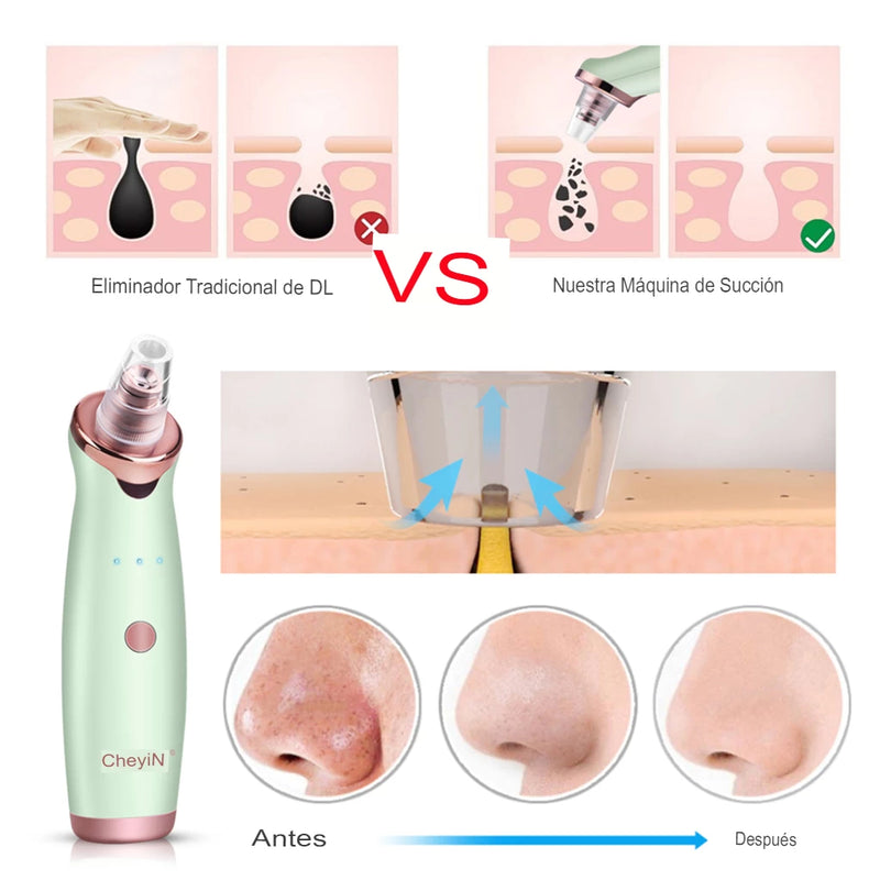 Electric blackhead remover - CkeyiN, acne pores and skin